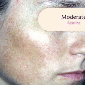 Tretinoin Cream for Melasma treatment.