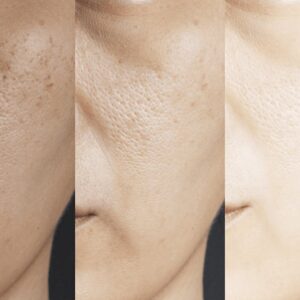 Tretinoin cream for skin lightening.