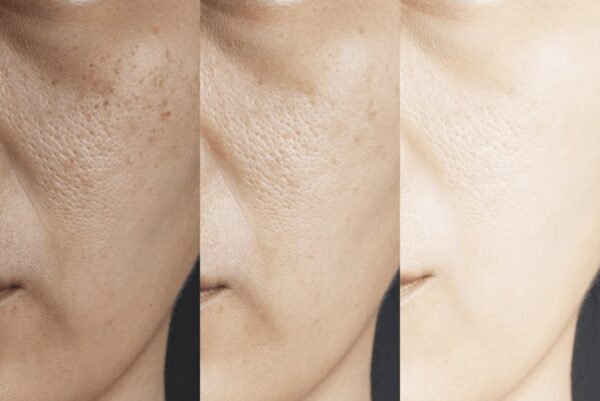 Retinol and hydroquinone skincare set.