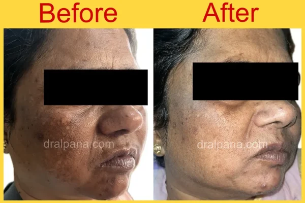 Hydroquinone cream before & after: showing skin improvement.
