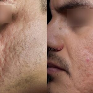 Tretinoin cream for scar treatment.