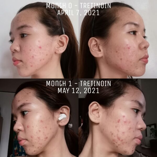 Tretinoin Uglies Reddit: Before & After photos showing skin improvement.