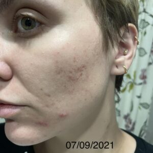 Tretinoin Cream 0.025% tube