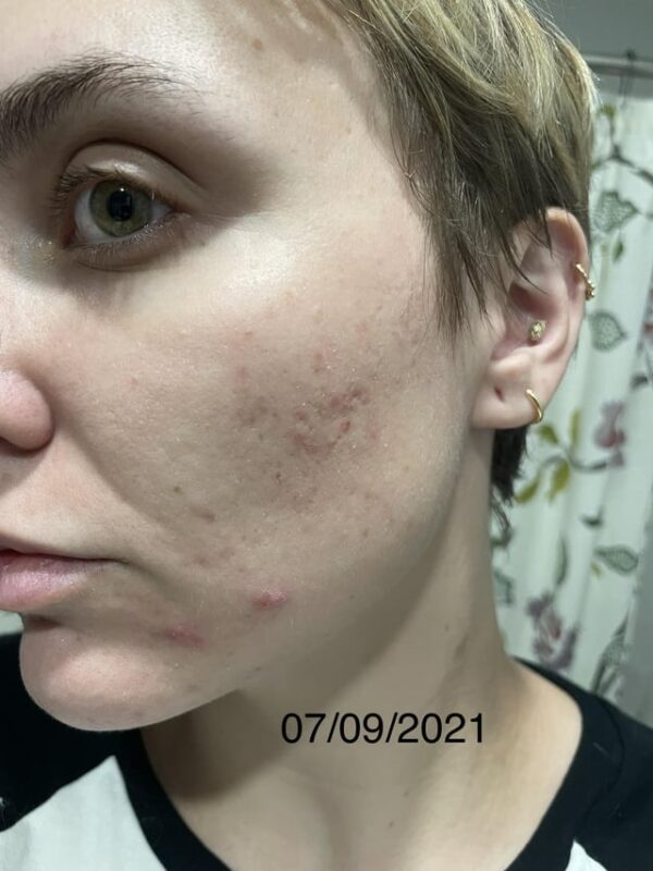Tretinoin 0.025% cream tube
