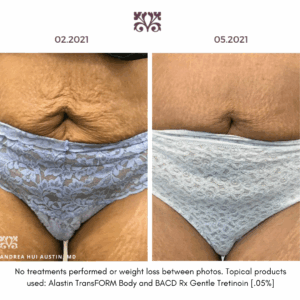 Tretinoin 0.05% before & after results. See visible skin improvement.