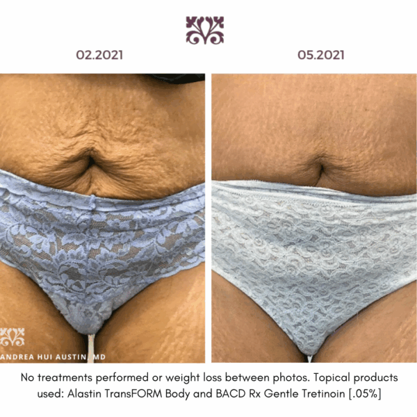 Tretinoin 0.05% before & after results. See visible skin improvement.
