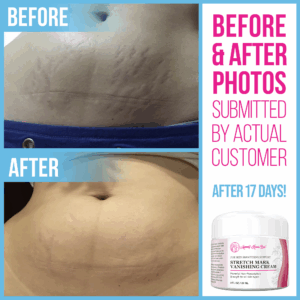 Tretinoin cream before & after: stretch mark treatment.