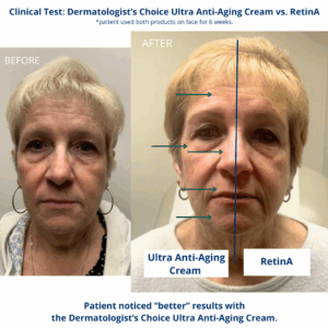 Tretinoin cream before & after wrinkle treatment.