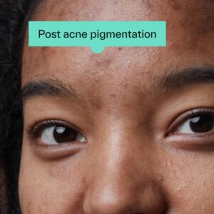 Tretinoin cream for hyperpigmentation treatment.
