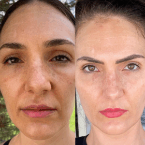 Before & after photos showing tretinoin treatment for melasma.