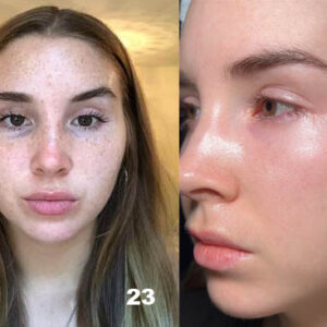 Tretinoin cream for reducing freckles.