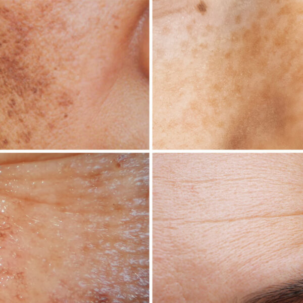 Tretinoin cream for sun-damaged skin.