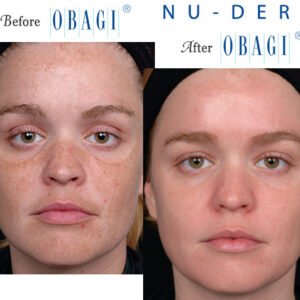 Obagi Tretinoin before & after: showing improved skin texture & tone.