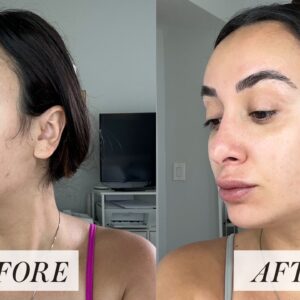 Tretinoin cream before & after: showing improved skin texture.