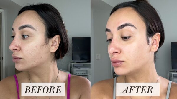 Tretinoin 0.1% before & after results. See visible skin improvement.
