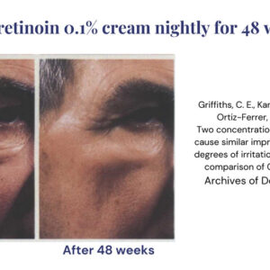 Tretinoin 0.025% cream before & after results.
