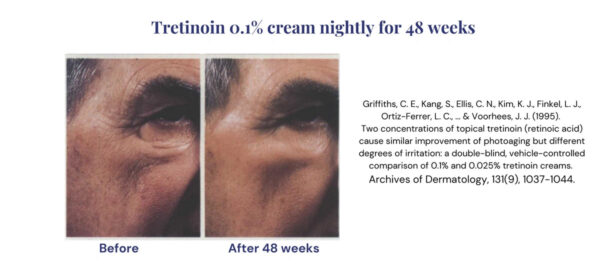 Tretinoin 0.025% cream before & after results.