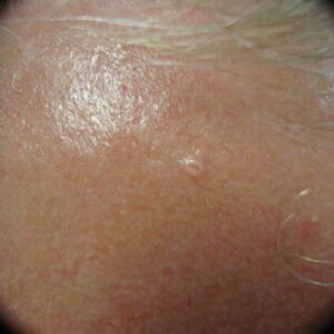 Tretinoin cream for sebaceous hyperplasia treatment.