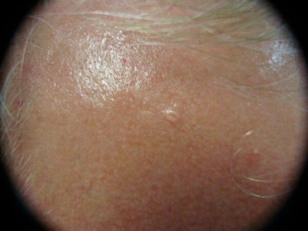 Tretinoin cream for sebaceous hyperplasia treatment.