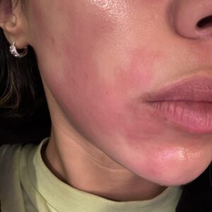 Tretinoin-induced redness and peeling. Illustrative image of skin irritation.