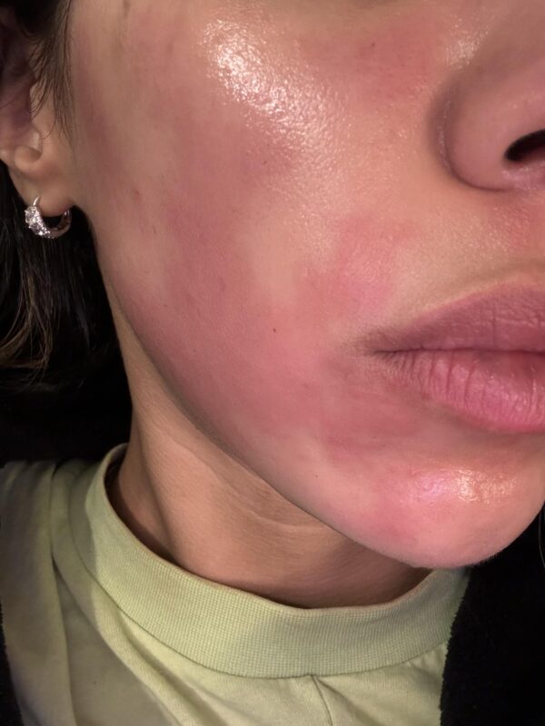Tretinoin-induced redness and peeling. Illustrative image of skin irritation.