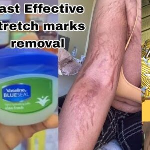 Stretch Mark Cream with Tretinoin.