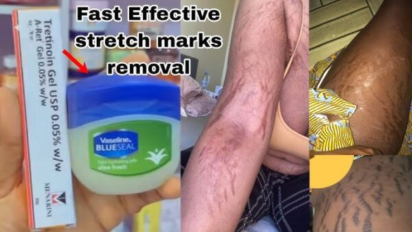 Stretch Mark Cream with Tretinoin.