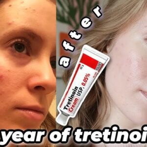 Tretinoin 0.05% before & after results. See skin improvement.