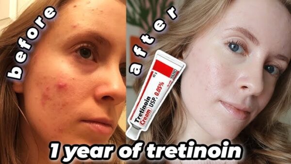 Tretinoin Cream 0.05% before & after results.
