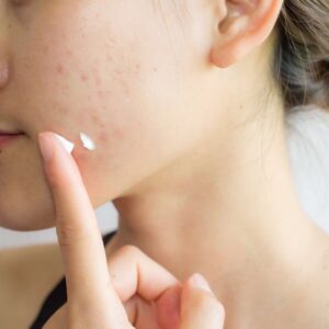 Tretinoin cream for skin lightening.