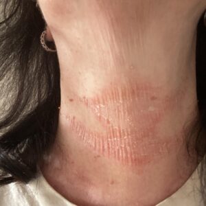 Tretinoin cream for neck wrinkles.