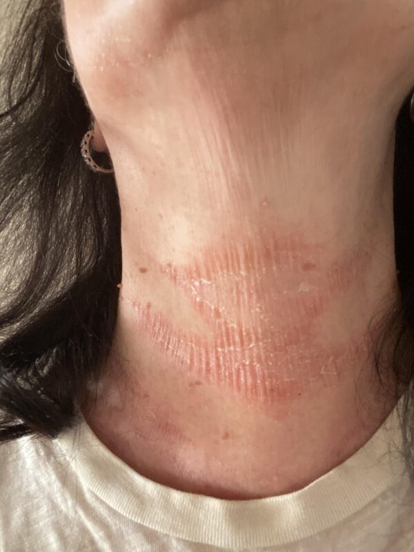 Tretinoin cream for neck wrinkles.
