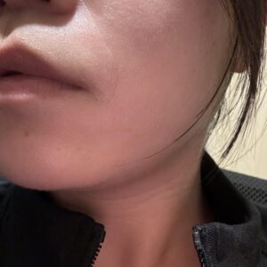 Tretinoin cream for nasolabial folds.