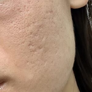Tretinoin cream for ice pick scar treatment.