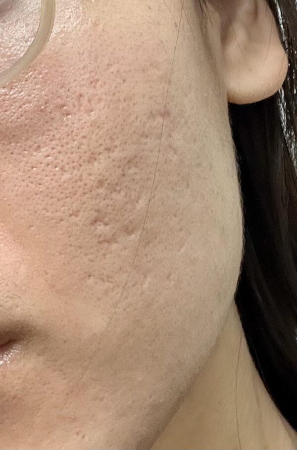 Tretinoin cream for ice pick scar treatment.