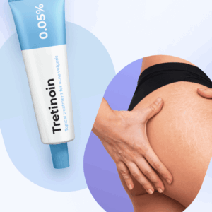 Hyaluronic acid & tretinoin stretch mark cream.