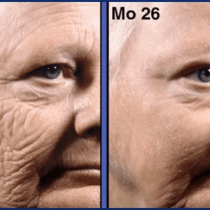 Tretinoin 0.25% cream before & after results.