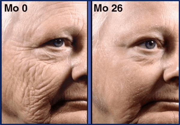 Tretinoin 0.5% cream before & after results. See noticeable skin improvement.