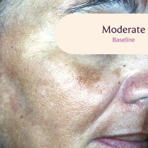 Triluma before & after: showing skin improvement.